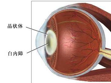 白内障需提前预防 患者术后需谨慎--寻医问药网