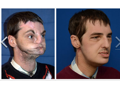 脸部移植6个月后 男重获第二张脸